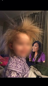 What is Wooly Hair Nevus or Wooly Hair Syndrome, you ask? Ok maybe you didn’t ask, but imma gonna tell ya! #drpimplepopper #pimplepopping #dermatology #popaholics | Dr Sandra Lee aka drpimplepopper