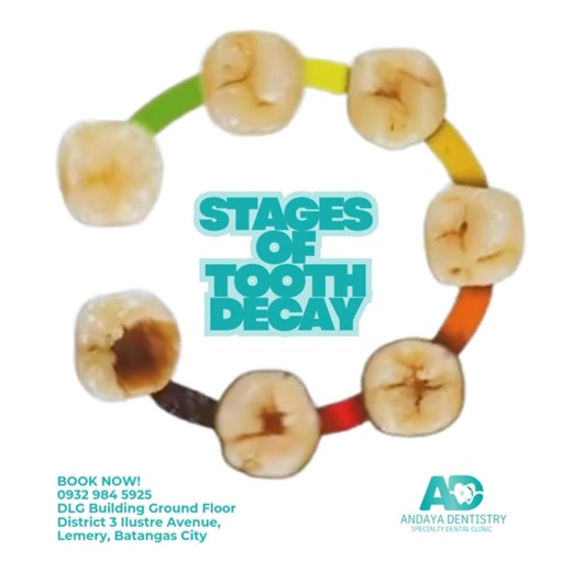 From early enamel demineralization to deep cavities, each stage is a warning sign your smile needs attention. Don’t wait for pain to tell you something’s wrong, book your appointment today and keep your teeth healthy at every stage. For Inquiries: 0932 984 5925 DLG Building Ground Floor, District 3 Ilustre Avenue, Lemery, Batangas City #andayadentistry #andayadmd #dentalclinic #dentist #familydentistry #hospitaldentistry #batangas | Andaya Dentistry - Specialty Dental Clinic - Lemery