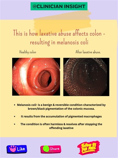 Melanosis Coli: Understanding a Benign Colonic Condition