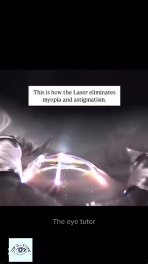 This how laser work in PRK and LASIK surgery🤯#lasik #refractivesurgery #lasertreatment #eyehealth