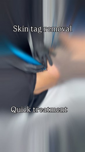❄️ CryoPen offers a precise and effective way to remove skin imperfections such as skin tags and lesions. Using targeted cryotherapy, it freezes the lesion with minimal discomfort and no damage to surrounding skin. Book your consultation today to see if CryoPen is suitable for you. #skintagremoval #cryopen #skinlesionremoval #clinic #skin #wigston #leicester #ndskin | ND Skin Aesthetics