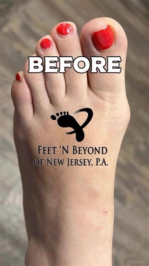 Bunion Surgery Without Pins or Screws? See the Result 👀