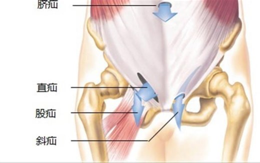 【人解】5分钟了解腹股沟管和腹股沟疝