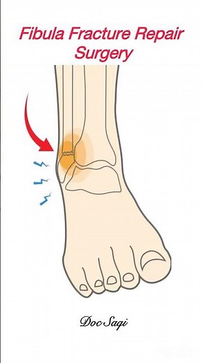 Fibula bone fracture repair surgery | #surgicalprocedure #fibula #ortho #shorts #medical #health