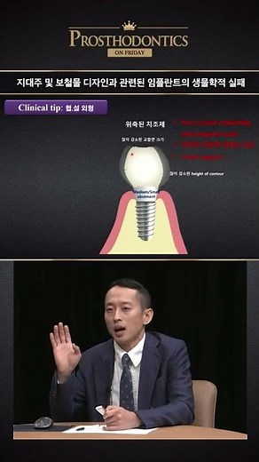 덴올_금요보철_임플란트 보철 디자인 #shorts