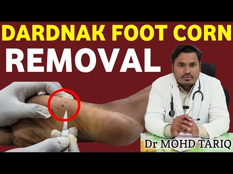 Dardnak Foot Corn Removal | Live Procedure by Doctor | Corn Treatment