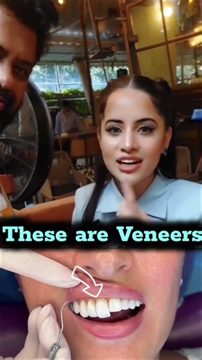 Most celebrities get veneers, cost 8k-25k/tooth #veneers #teeth #rebelkid #smiledesigndental #smile