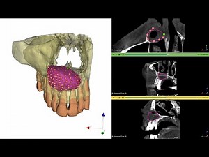 Free Surgical Planner:Segmentation & Quantification of Jaw Bone Cystic Lesions on 3D Slicer platform