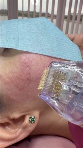 Watch this Microneedle rf #sacdepspa #skincare #microneedling