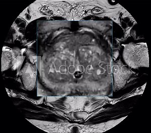 MRI scan reveals an enlarged prostate gland, a possible indicator of prostate cancer. Explore the critical signs and how MRI can assist in early detection.