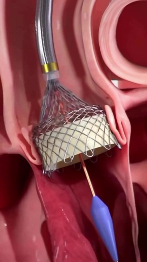 Understanding Trocavalvar and Valvular Stenosis - Abbott Heart Valve