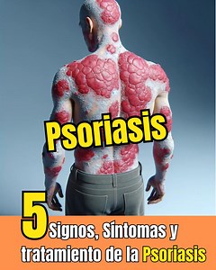 5 signos de psoriasis causas y tratamiento | Diabetes Tipo 2