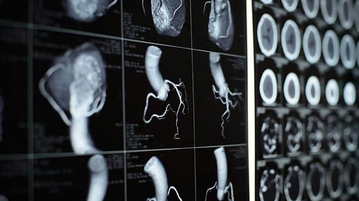 La coronarographie : définition, indication et déroulement de l'examen