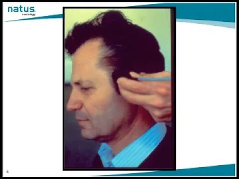 Natus TCD Webinar: TCD Techniques and Tips