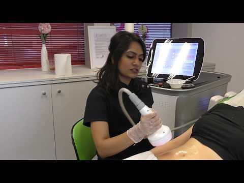 Radio Frequency Skin Tightening - Stomach