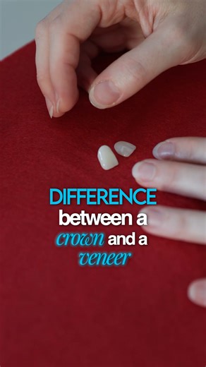Ever wondered what the real difference is between a crown and a veneer? At The Pampered Tooth in Port Orange, FL, we hear this question all the time! Both can use the same strong, beautiful materials, but they serve slightly different purposes. A crown covers your entire tooth 360 degrees providing full protection and support. A veneer, on the other hand, just covers the front surface, letting your natural tooth show in the back. Understanding these options helps you make the best choice for you