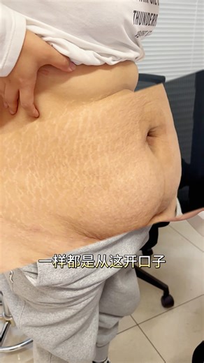 腹壁整形术整整切掉7斤赘皮！这总不至于是P的了吧