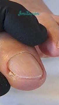 Pies Saludables. Paciente tercera edad. Heloma subunqueal (callus debajo de la uña) Sencillo