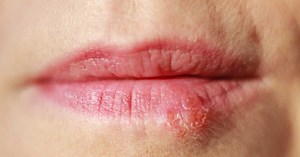 Cancer de la lèvre : signes précoces, causes, diagnostic et traitements