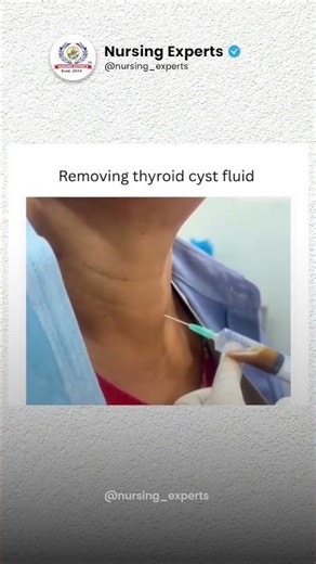 🩺 Removing Thyroid Cyst Fluid | Real Clinical Procedure Explained | Nursing Experts