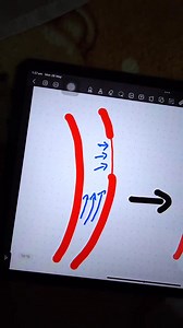 188K views · 3.3K reactions | subarachnoid hemorrhage | تعليم الأشعة المقطعية - أشرف الشاعر | Facebook