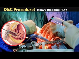 D&C Procedure Explained: Why It’s Done, How It Works & Risks #gynecology #womenshealth #uterushealth