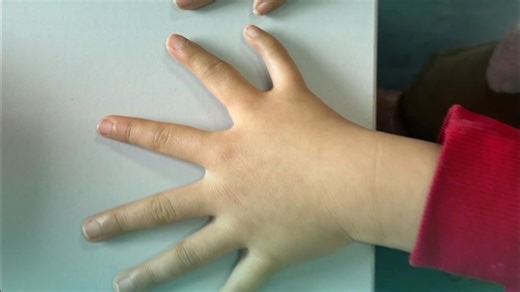 与众不同的“6指”，你知道切掉哪一根吗？
