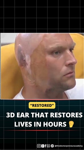 7.1K views · 31 reactions | A new 3d-scanned prosthetic ear is changing lives—restoring not just faces, but confidence, in under 48 hours. ✅ Perfect fit with 0.1mm scan ✅ 150 skin tones, seamless match ✅ Zero recovery, full reintegration Medicine meets digital art and the results are life-changing. #healthcare #3dprinting #prosthetics #innovation #medicaltech #futureofmedicine #patientsfirst #technology | Dr Pranav Sharma | Facebook