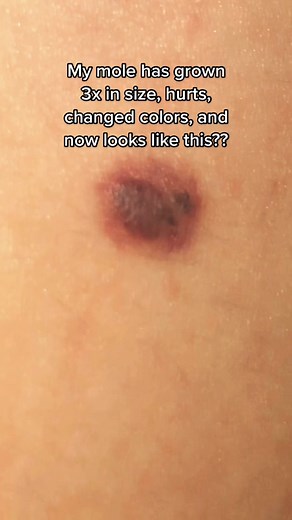 Concerned About Mole Growth? Understand the Signs and Symptoms