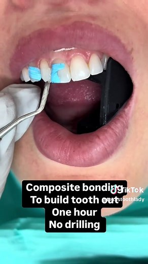 One Hour Composite Bonding for Front Tooth Restoration