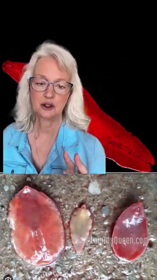 Do a liver flush to remove flukes and stones from the liver, gall bladder, and ducts. Our free health ebook on our website explains how. Also use our herbal parasite cleanse powder or tincture. Use binders to help remove toxins after parasites die off.More on Fluke parasites and gall stones ⬇️ Gallstones aren’t always just cholesterol. And this is where most people are never informed. While gallstones are commonly labeled as “cholesterol stones,” research and clinical findings have shown that pa