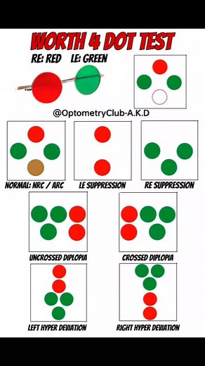 The Worth 4-Dot Test (W4D test) is a simple clinical test used in binocular vision assessment. It helps to check whether a patient is using both eyes together (binocular single vision), or whether one eye is being suppressed or the patient has diplopia (double vision). --- Principle: Uses four lights arranged as: 1 red (top) 2 green (left and right sides) 1 white (bottom) The patient wears red-green goggles (red filter over Right eye, green over the left eye ). --- Interpretation: Normal binocul