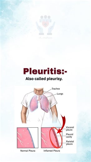 Dr. Nazmul_PT | Pleuritis, also known as pleurisy, is the inflammation of the pleura — the thin layers of tissue surrounding the lungs. It often causes... | Instagram