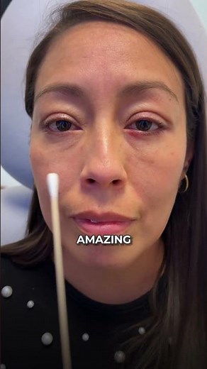 Here’s a stunning before and after of a lower blepharoplasty with skin pinch and canthopexy.