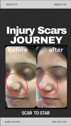 Nose Scar Transformation Journey | Before & After Scar Surgery by Dr Anvika