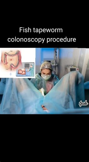 Fish Tapeworm Infections: Symptoms, Complications, and Colonoscopy Procedure