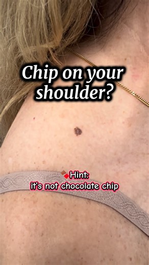 Dr. Mathieu Powell, MD on Instagram: "Got a chip on your shoulder? 🍪 Time to chip in with the right answer! 👇 🍫 If you said A, I don’t blame you! This one had a lot of ABCDE features that scream “melanoma.” But the biopsy result? ➡️ Low-grade dysplastic nevus. Correct answer: D ✅ 🧠 Here’s how I reasoned through it: A (Melanoma): Definitely on the table — asymmetric, irregular, dark. We biopsied to be safe. B (Compound nevus): Too irregular for a classic benign pattern, though some overlap. C