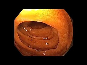 EGD - 5 - Duodenum screening