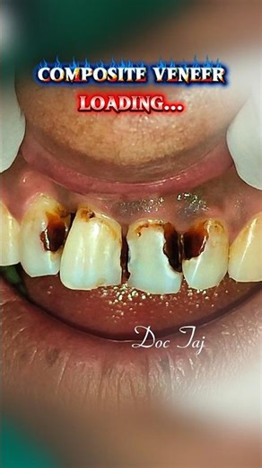 Decayed front teeth treated with Composite Veneering within 2 hrs by Doc Taj #composite #veneers