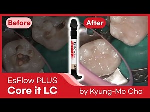 EsFlow PLUS Core it LC | #46 BO endodontic cavity filling