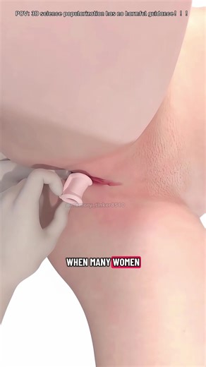 Vaginal pessary ring insertion 3d animations. #pessaryring #pelvichealth #MedicalEducation #SurgicalProcedure #HealthAwareness