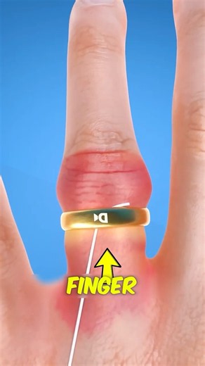 The Safe Way to Remove a Stuck Ring! 💍😱