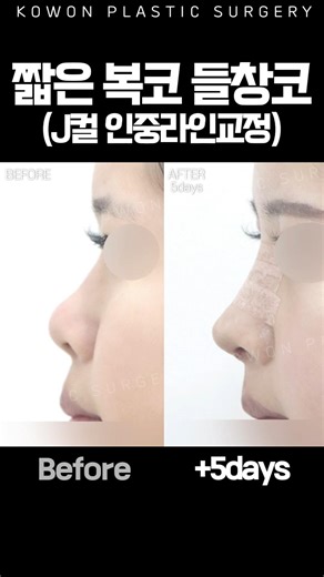 짧은 복코·들창코, J컬 인중라인 교정