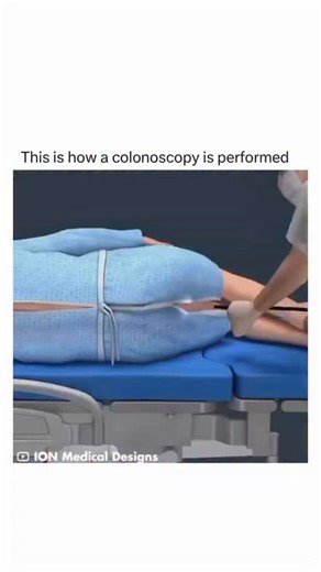 CR 7 on Instagram: "Colonoscopy is a medical procedure that allows the doctor to examine the inner lining of the large intestine, which includes the rectum and colon. A device called a colonoscope is used, which is a long flexible tube equipped with a video camera at the tip, allowing direct visualization of the entire colon and rectum. During the procedure, the doctor can also perform interventions, such as removing polyps or collecting biopsies, which are small tissue samples for more detailed