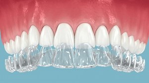 Invisalign braces or invisible retainer installation on teeth. Dental 3D animation