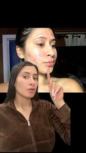 458K views · 16K reactions | THE ACNÉ SOLUTION 﫶#greenscreen #acne #acnetreatment | Itati Lopez Fans | Facebook