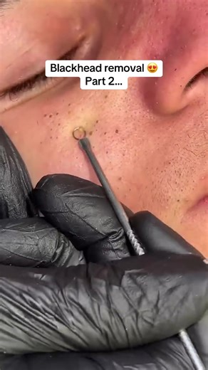 Effective Blackhead Removal Techniques for Clear Skin