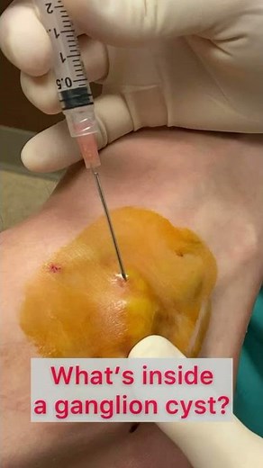 What’s inside a ganglion cyst!? | Dr. Nick Campitelli #shorts