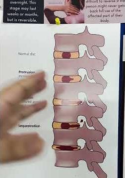 Understanding Disc Protrusion and Facet joint Pain: The Bigger Picture