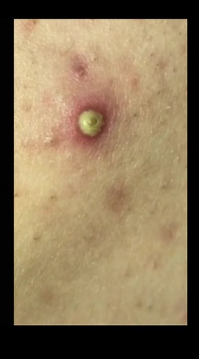 #duet with @dr.priw #extraction #popping #zit #zitpop #pimpleremover #pimple Cant wait